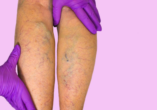 To treat varicose veins with coconut oil