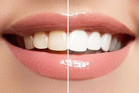 How Can You Whiten Teeth Naturally?