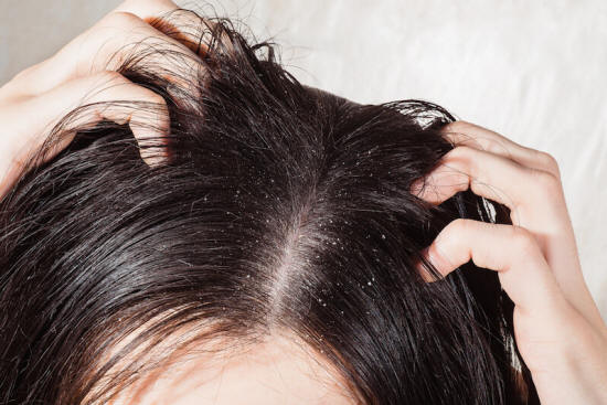 Dandruff is often caused by scalp infections